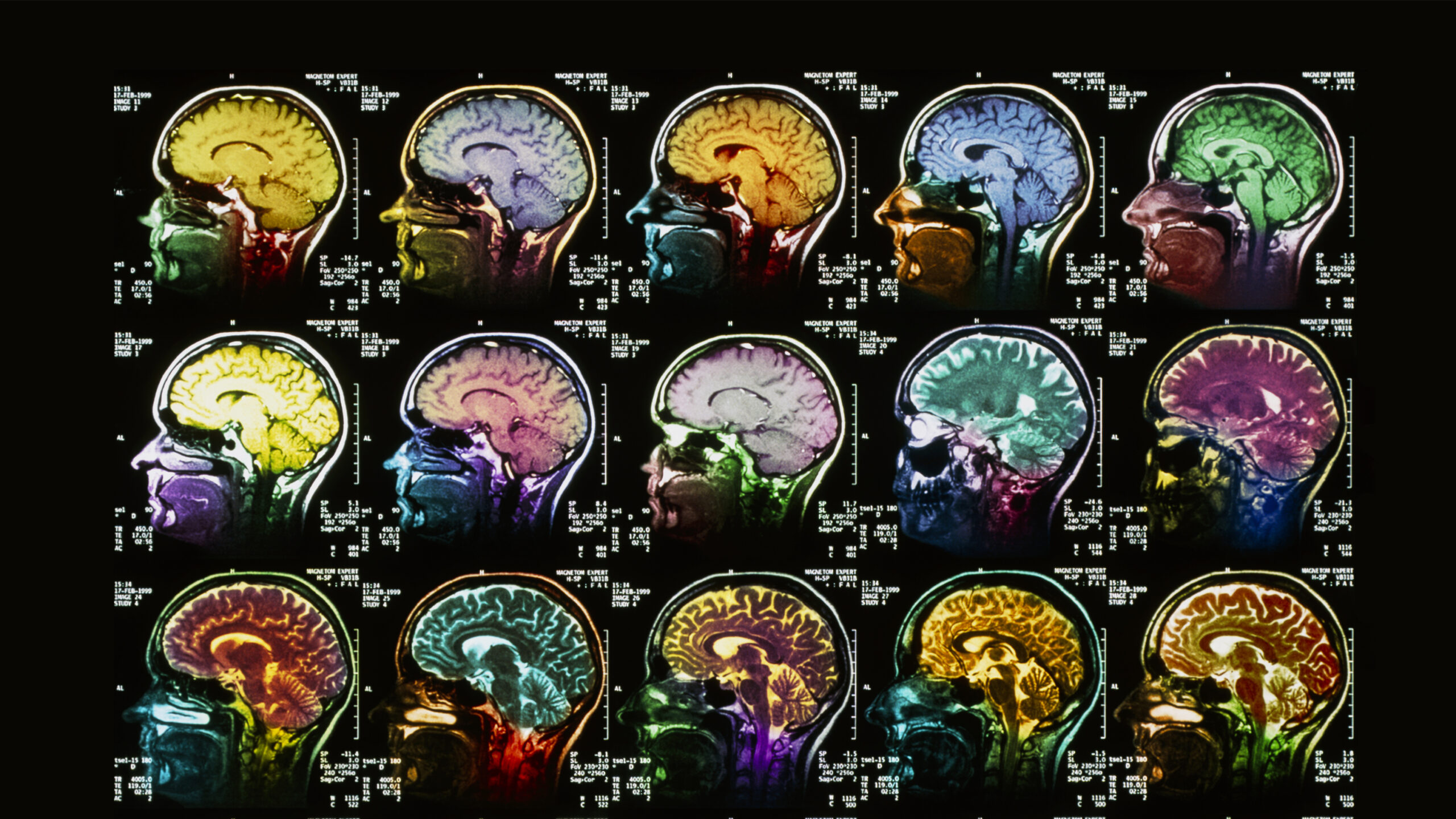 Image: Sagittal, MRI views of the brain symbolizing the rigorous & exceptional the medical training of Board Certified psychiatrist Dr. Mary E. Theodore.